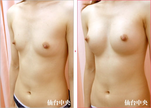 人工乳腺による豊胸術 症例写真3