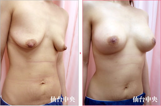 胸の下垂修正乳頭縮小術後 症例写真2