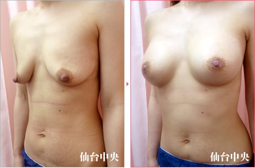 胸の下垂修正乳頭縮小術後 症例写真3