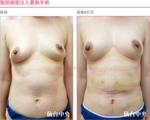脂肪細胞注入豊胸手術 症例写真