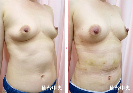 脂肪細胞注入豊胸手術 症例写真2