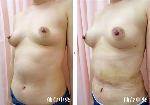 脂肪細胞注入豊胸手術 症例写真3