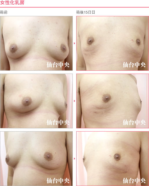 女性化乳房 症例写真