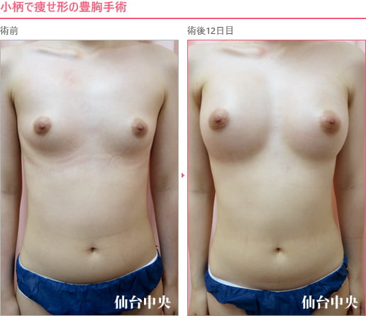 小柄で痩せ形の豊胸手術 症例写真