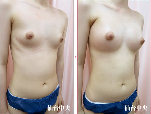 小柄で痩せ形の豊胸手術 症例写真2