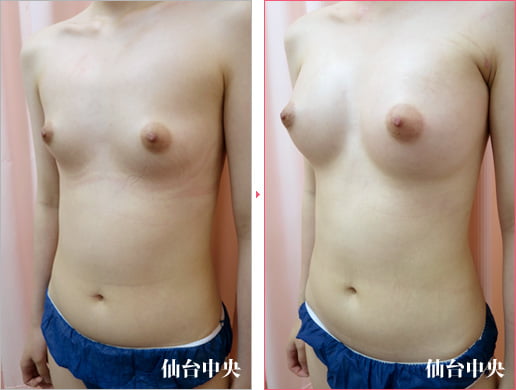 小柄で痩せ形の豊胸手術 症例写真3