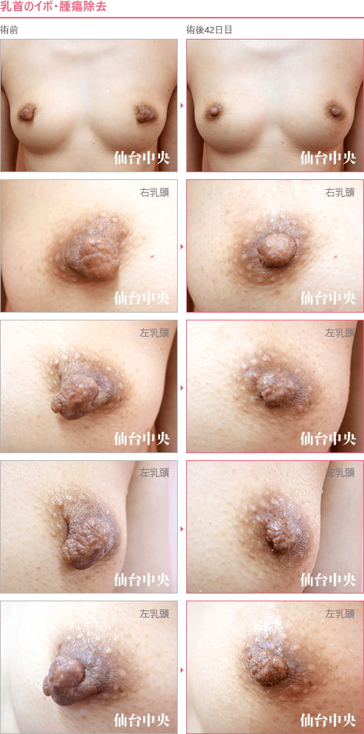 乳首のイボ・腫瘍除去 症例写真