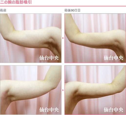 二の腕の脂肪吸引 症例写真