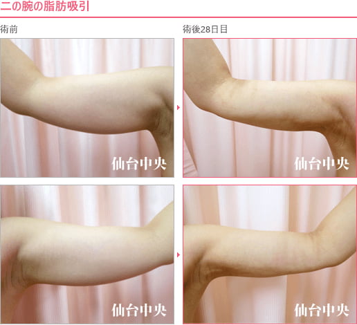 二の腕脂肪吸引 症例写真