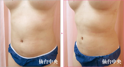 上下腹部側腹部脂肪吸引 症例写真3