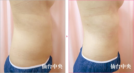 上下腹部側腹部脂肪吸引 症例写真4