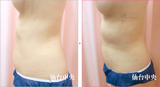 上下腹部側腹部脂肪吸引 症例写真5