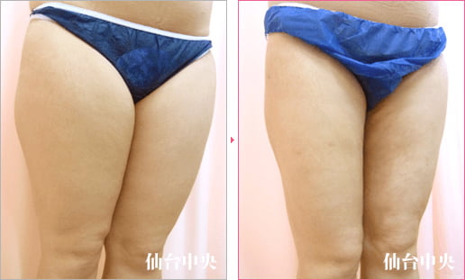 大腿臀部脂肪吸引 症例写真2