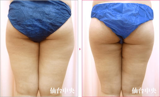 大腿臀部脂肪吸引 症例写真4
