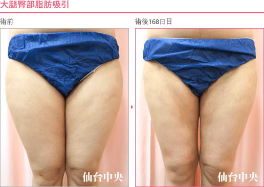 大腿臀部脂肪吸引 症例写真