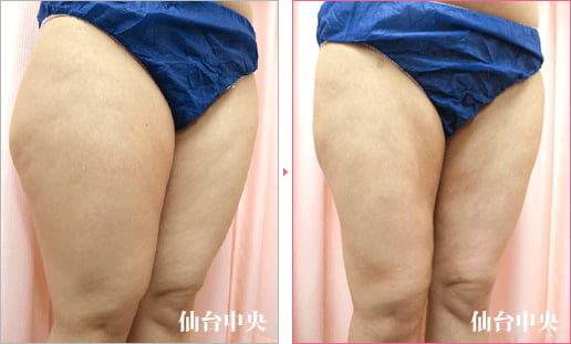 大腿臀部脂肪吸引 症例写真2